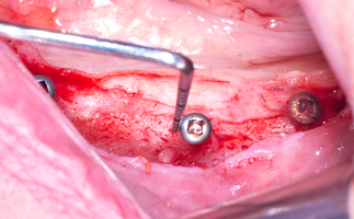 RBB 05. Операция установки имплантатов в новую кость